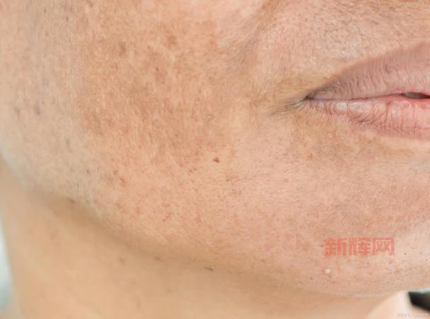 90后女孩因熬夜10年长老年斑，警惕熬夜危害健康